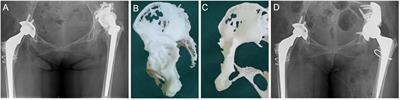 Use of Customized 3D-Printed Titanium Augment With Tantalum Trabecular Cup for Large Acetabular Bone Defects in Revision Total Hip Arthroplasty: A Midterm Follow-Up Study